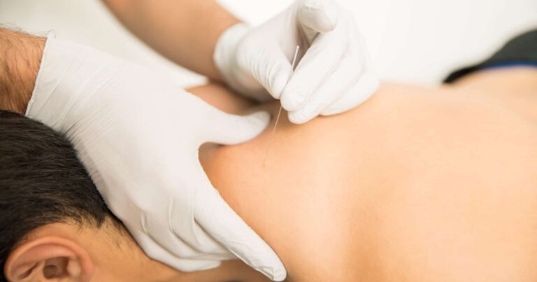 Dry needling treatment being performed by a physical therapist