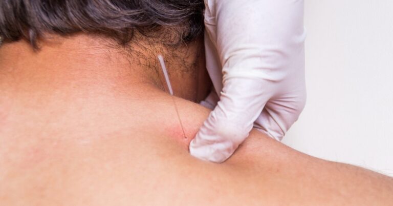 Dry needling treatment being performed on a patient's neck