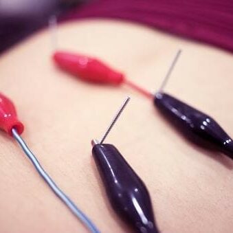 Dry needling needles used during treatment