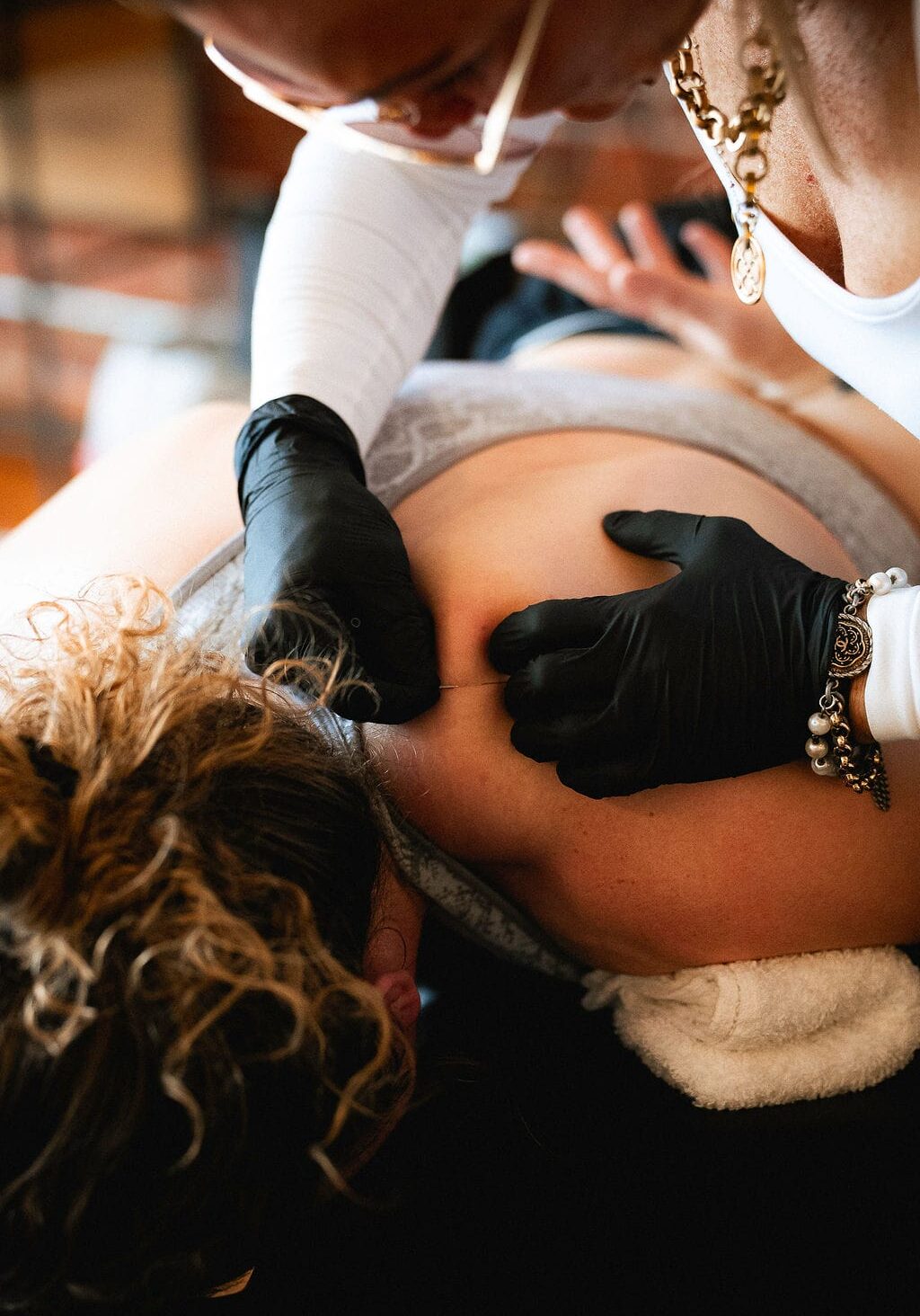 Physical therapist performing dry needling on a patient’s upper back/shoulder area while the patient lies face down on a treatment table.