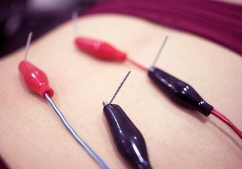 dry-needling dry-needling