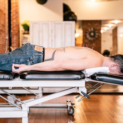 shirtless man lying on therapy table with dry needles in his back