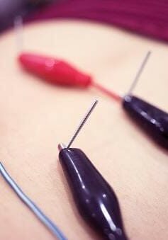 dry-needling