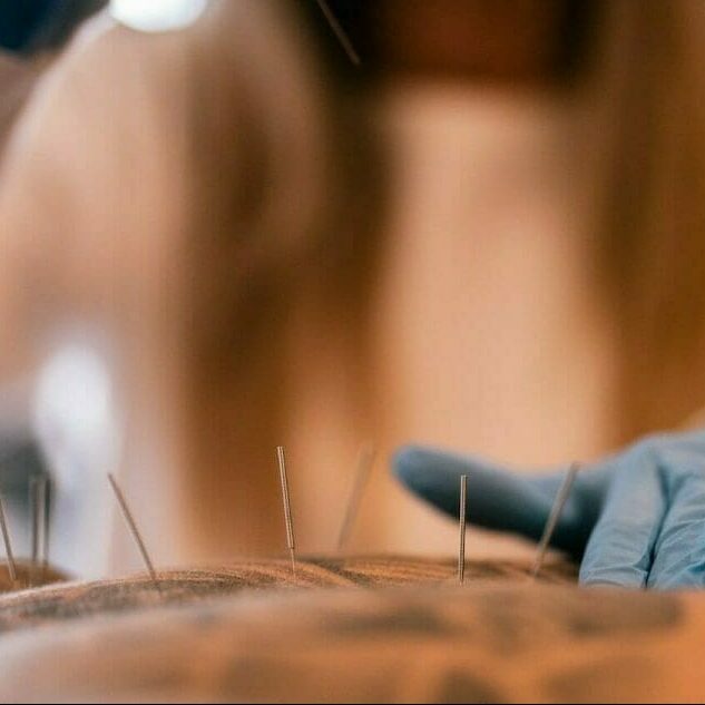 a therapist performing a dry needling at the back of the man with tattoo